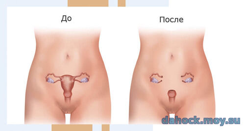 Удаление матки (гистерэктомия, ампутация матки, экстирпация матки)